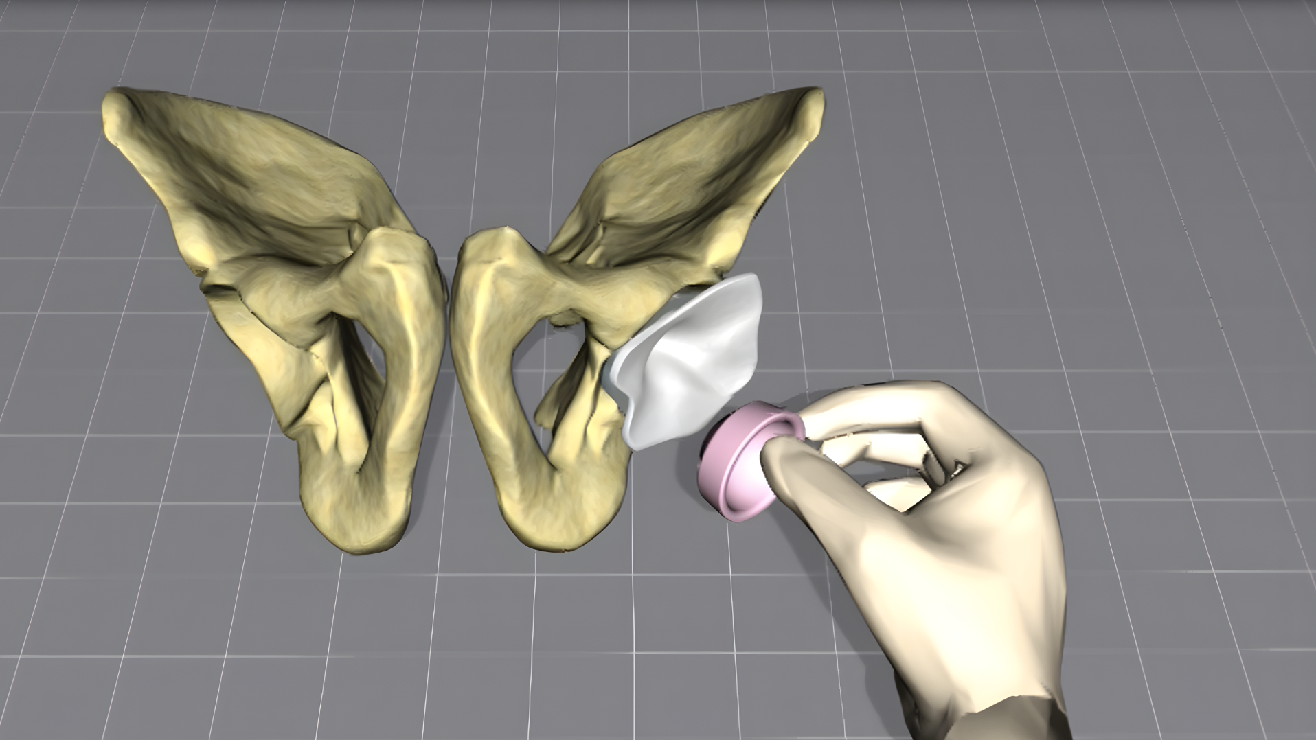 Acetabular Cup Placement in Total Hip Arthroplasty
