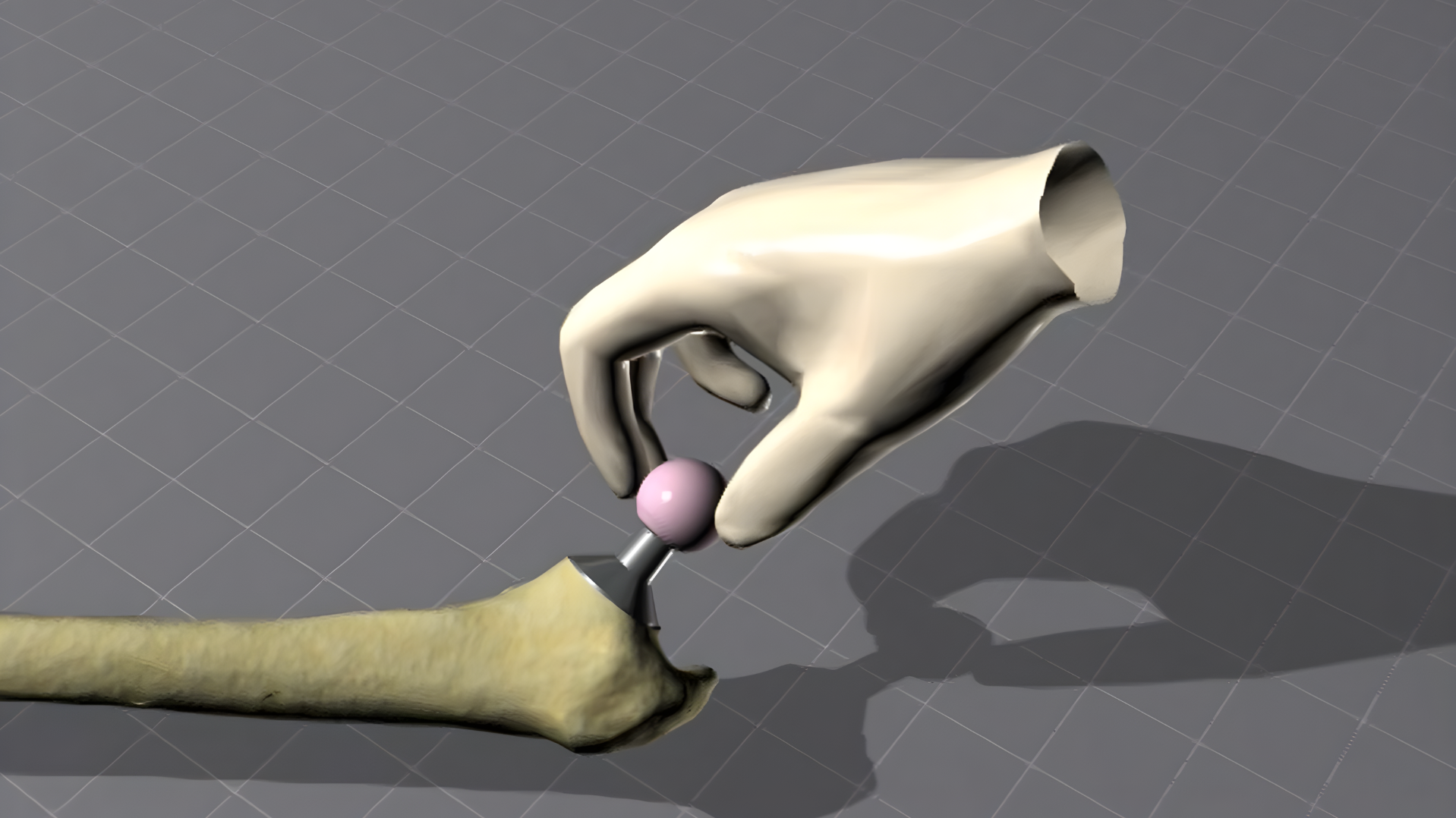 BIOLOX® Ceramic Femoral Head Placement in THA Surgery